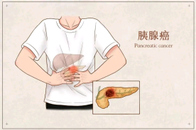 防范胰腺癌需重视早期筛查与随访