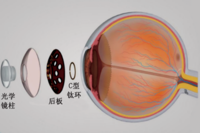 患者眼部受化学伤害 人工角膜移植术成功实施