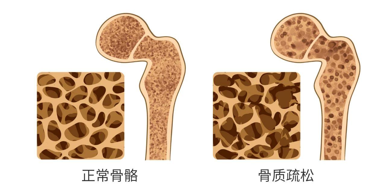 骨密度低≠吃钙片！科学方法才最有效→