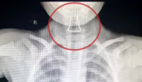 [危險]4歲女童誤吞鋼絲卡食道口  醫生妙手取出