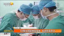 60厘米钢筋横穿身体  生命危在旦夕