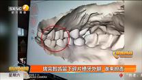 拔完智齿留下碎片槽牙外翻 谁来担责