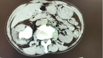 西安医学院第一附属医院泌尿外科成功清除巨大铸型结石