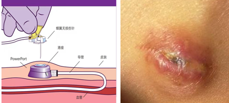 输液港留置期间,可能会出现一些并发症,如果您发现港体部位红,肿,热