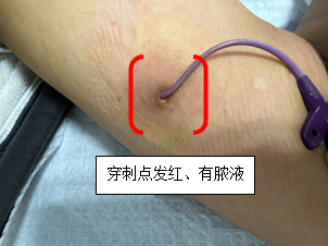 穿刺点及局部红肿,有炎性分泌物出现肌肉酸痛,寒战,发抖,发热等.