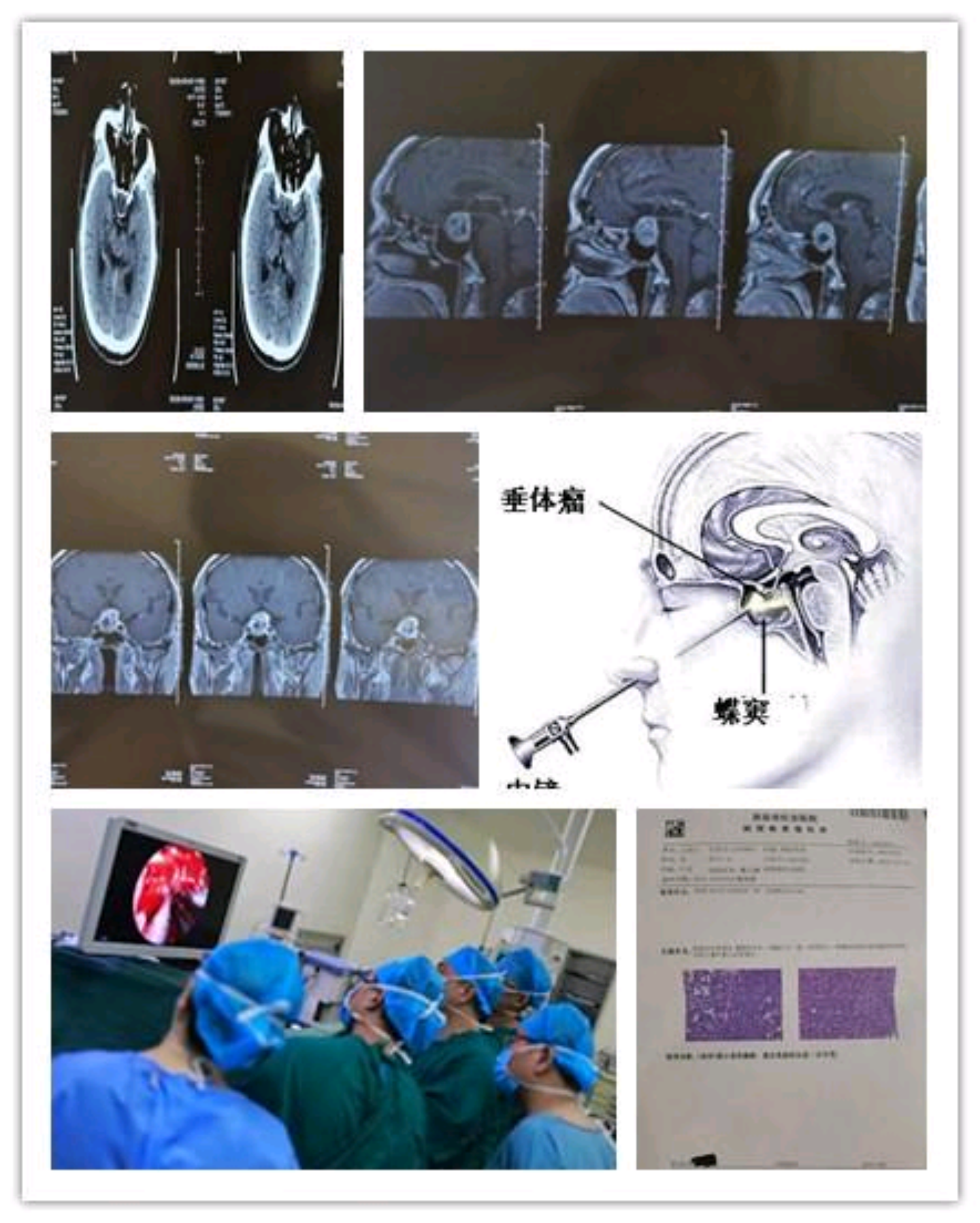 西安市红会医院神经外科完成院首例经鼻蝶神经内镜下垂体瘤切除术