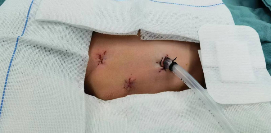 罕见新生儿巨大肺囊腺瘤胸腔镜微创手术在西安交大二附院成功实施