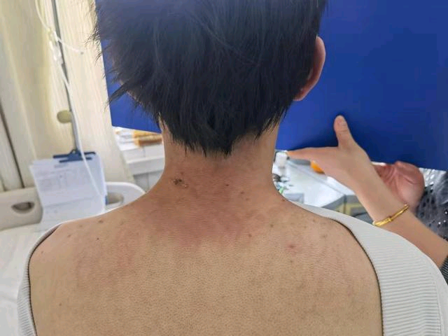 18岁小伙肌肉酸痛无力以为是感冒就诊后确诊皮肌炎