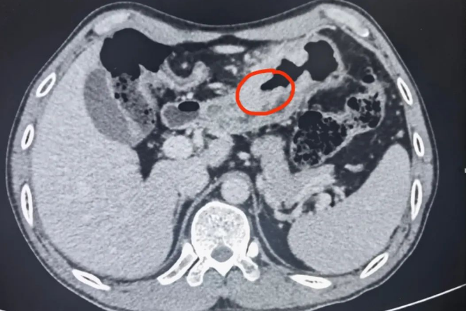 腹疼半年以为胆囊炎检查后发现是胃癌