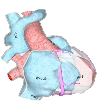 > 术前:上腔静脉与右肺动脉连接3d打印心血管模型为进一步明确诊断